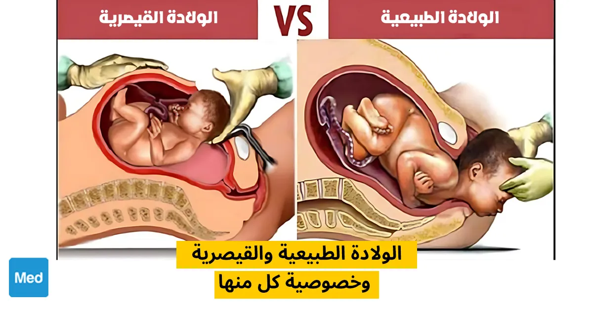 الولادة الطبيعية والقيصرية وخصوصية كل منها